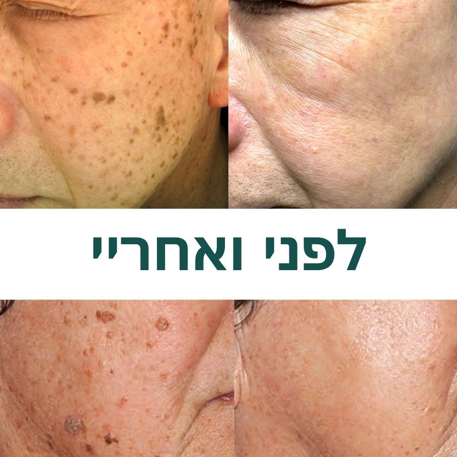 PerfekteHaut™ | ג'ל מיידי להסרת שומות וכתמים